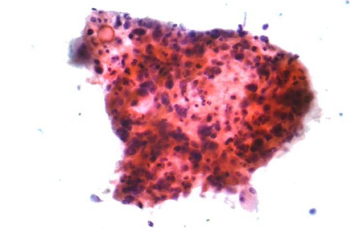 La primera descripción de células malignas en el esputo fue reportada por W. H. Washe.1 Ahora las pruebas del esputo se hacen para detectar el cáncer del pulmón.1Long, S.R. and Cohen, M.B. "Classics in Cytology VI: The Early Cytologic Discoveries of Lionel S. Beale." Diagnostic Cytopathology. 9 (1993): 595-598. [PUBMED]      