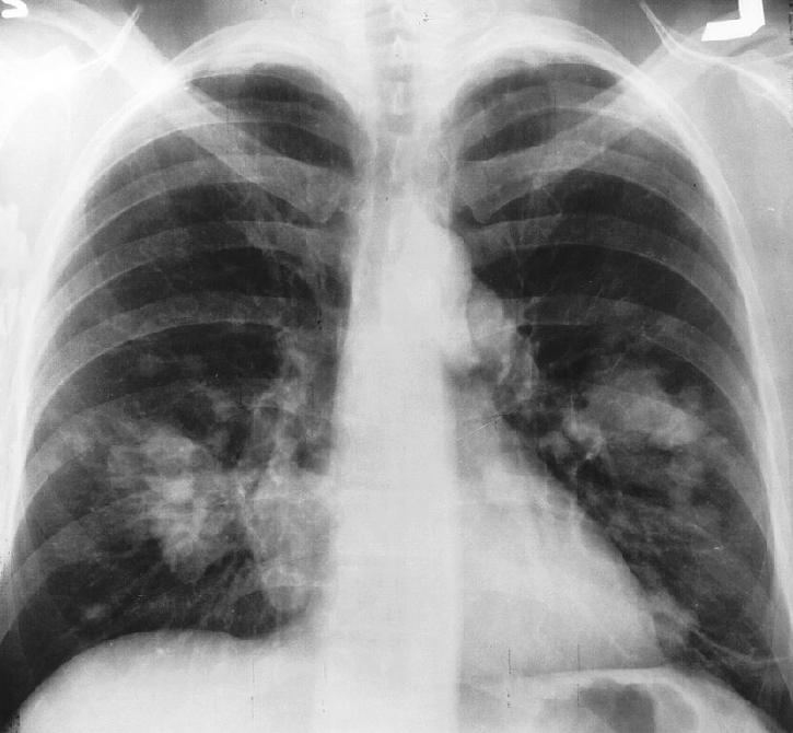 Lung Cancer Detection through X-ray