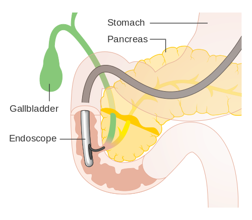The first endoscopic retrograde cholangio-pancreatography (ERCP), an endoscopic procedure used to diagnose cancer in the bile ducts and pancreas, was performed by Dr. William McCune. 11McCune, W.S. et al. "Endoscopic Cannulation of the Ampulla of Vater: A Preliminary Report." Reprinted in: Gastrointestinal Endoscopy. 34 (1988): 278-280. [PUBMED]      