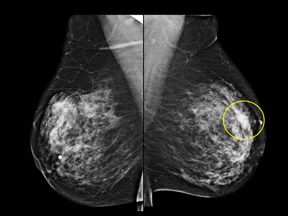 Breast Cancer on Mammogram