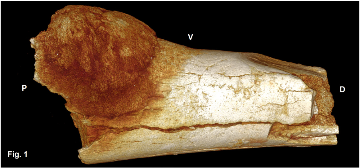Aunque a menudo se considera que el cáncer es una enfermedad moderna, está claro que el cáncer ha sido una plaga para los humanos y sus ancestros desde la prehistoria.Se conoce que uno de los cánceres más antiguos que han afectado a homínidos, es el osteosarcoma (mostrado en la foto de arriba). El crecimiento de este cáncer se manifestó en el quinto metatarso (el hueso del dedo) de un ancestro humano que vivió hace 1.7 millones de años atrás. Este hueso se encontró en la cueva Swartkans en Sudáfrica. 1Existen evidencias para un cáncer aun mas antiguo en otros homínidos. El esqueleto de un joven Australopithecus sediba de Malapa, Sudáfrica ha presentado evidencias de cáncer en su sexta vértebra torácica.2 Se piensa que este cáncer surgió hace casi 2 millones de años atrás. 1Odes EJ, Randolph-Quinney PS, Steyn M, Throckmorton Z, Smilg JS, Zipfel B, et al. Earliest hominin cancer: 1.7-million-year- old osteosarcoma from Swartkrans Cave, South Africa. S Afr J Sci. 2016;112(7/8), Art. #2015-0471, 5 pages. http://dx.doi. org/10.17159/sajs.2016/20150471 [Earliest hominin cancer: 1.7-million-year- old osteosarcoma from Swartkrans Cave, South Africa.]                      2Randolph-Quinney PS, Williams SA, Steyn M, Meyer MR, Smilg JS, Churchill SE, et al. Osteogenic tumour in Australopithecus sediba: Earliest hominin evidence for neoplastic disease. S Afr J Sci. 2016;112(7/8), Art. #2015- 0470, 7 pages. http://dx.doi.org/10.17159/sajs.2016/20150470 [Osteogenic tumour in Australopithecus sediba: Earliest hominin evidence for neoplastic disease.]      