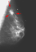 Abnormal Mammogram mammography