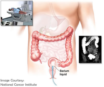 Barium Enema with Contrast double contrast barium enema