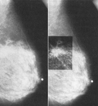 Normal Mammography vs Digital Mammography mammography images