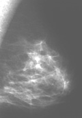 Normal Mammogram mammography