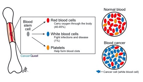 全血细胞计数 Cbc Cancerquest