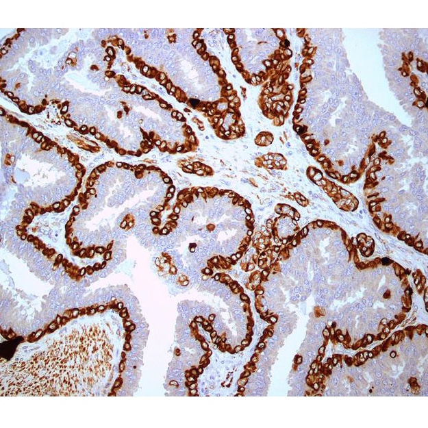 biphasic mesothelioma pathology outlines