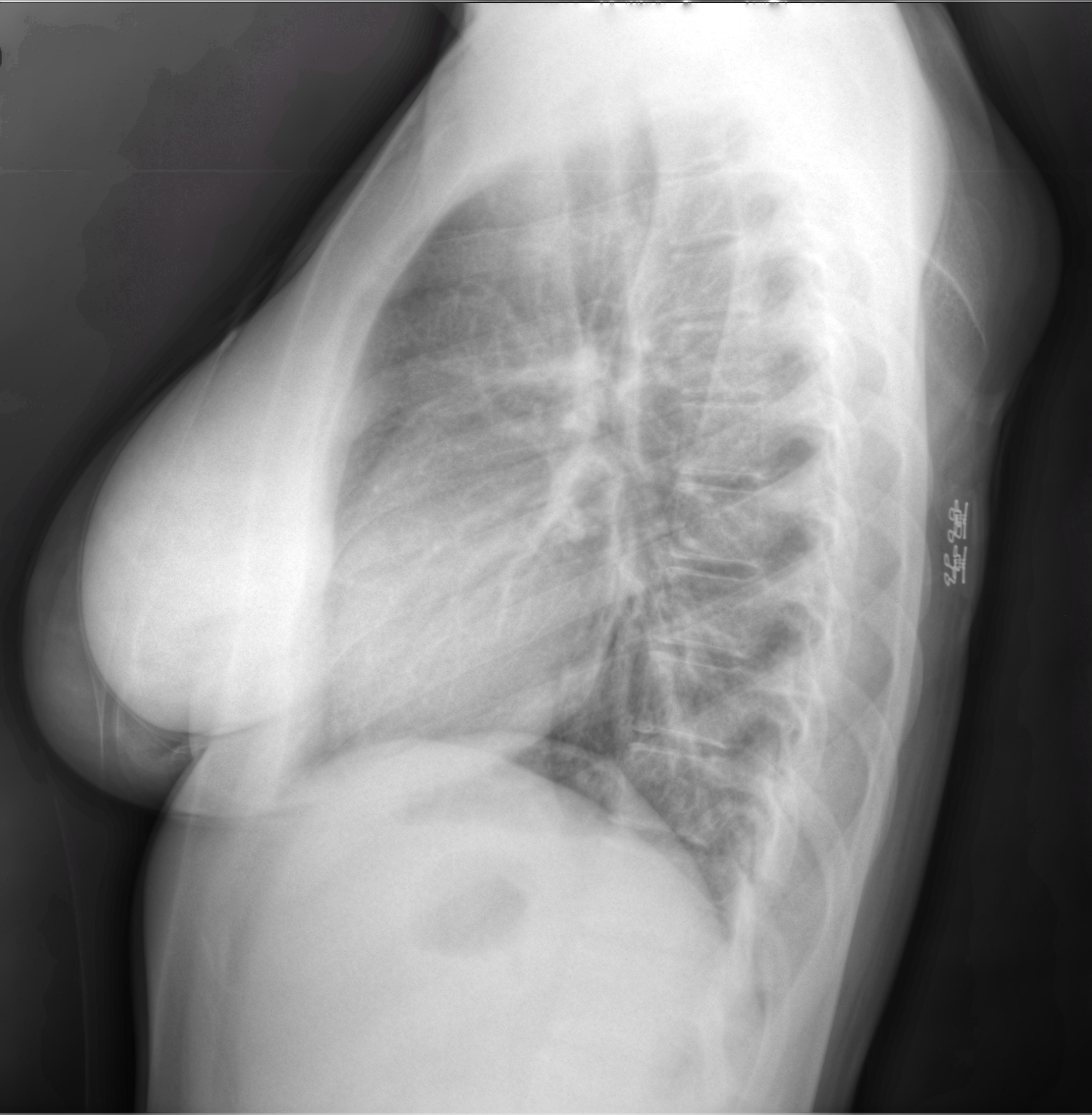 The use of x-rays for diagnostic examination of the breast was introduced in by Stafford Warren. His technique involved the patient lying on her side with her arm raised and having the picture taken from the side.11Warren, S.L. "A Roentgenologic Study of the Breast." The American Journal of Roentgenology and Radium Therapy. 24 (1930): 113-124.      