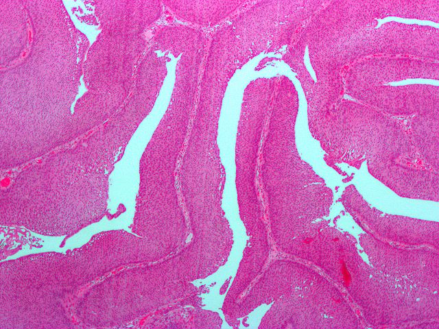 George N. Papinicolaou y Victor F. Marshall utilizaron la citología urinaria, examen de las células y otros materiales en la orina, para diagnosticar el cáncer de la vejiga.11Papinicolaou, G.N., and Marshall, V.F. "Urine Sediment Smears as a Diagnostic Procedure in Cancers of the Urinary Tract." Science. 101 (1945): 519-520. [PUBMED]      