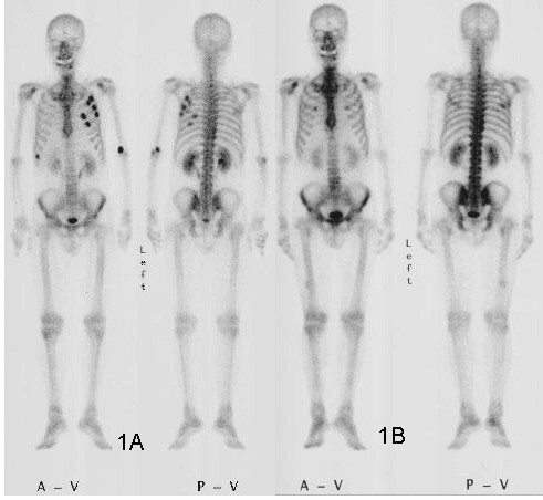 Gynning y su grupo utilizaron la cintigrafía ósea o el escaneo óseo con un isótopo radioactivo, utilizando el Sr85, como examen diagnóstico para la detección de metástasis espinales.11Gynning, I. et al. "Localization With Sr85 of Spinal Metastases in Mammary Cancer and Changes in Uptake After Hormone and Roentgen Therapy: A Preliminary Report." Acta Radiologica. 55 (1961): 119-128.      