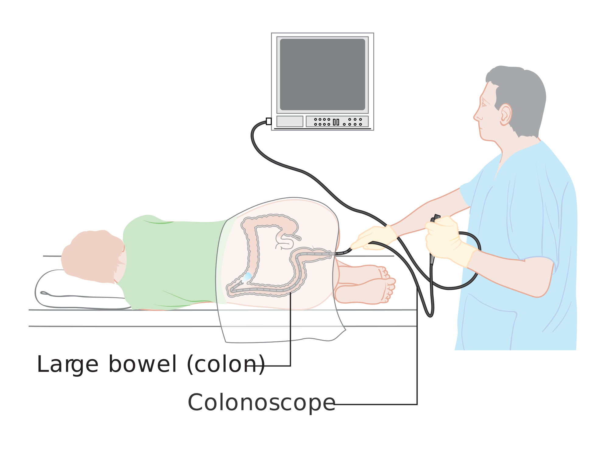 Retrograde colonoscopy of the entire colon was successfully administered by Dr. William Wolff and his associates.11Wolff, W.I. "Colonoscopy: History and Development." American Journal of Gastroenterology. 84 (1989): 1017-1025. [PUBMED]      