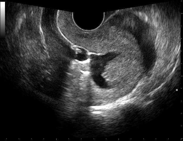 In this technique, fluid is used to expand the uterus and an ultrasound probe is inserted into the vagina. Sonohysterography is used in diagnosis of cancer of the endometrium and uterus, and was developed by Drs. Parsons and Lense. 11Parsons, A.K. and Lense, J.J. "Sonohysterography for Endometrial Abnormalities: Preliminary Results." Journal of Clinical Ultrasound. 21 (1993): 87-95. [PUBMED]      