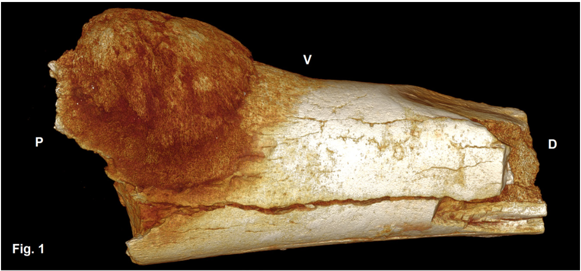 While it is often thought of as a modern disease, it is clear that cancer has been plaguing humans and their ancestors since the beginning of humankind. One of the oldest known cancers affecting a hominin is the osteosarcoma shown above. Osteosarcoma is a type of bone cancer. It is shown growing on the the 5th metatarsal (a bone in the foot) of a human ancestor who lived about 1.7 million years ago. The bone was found in the Swartkans cave in South Africa.1There is also evidence for an even older but non-cancerous tumor found in hominins. The skeleton of a young male Australopithecus sediba from Malapa, South Africa showed evidence of a tumor in his sixth thoracic vertebra.2 This growth is thought to have arisen almost 2 million years ago. Based on the characteristics of the growth and the patient, the tumor is thought to most likely be osteoid osteoma, a benign bone-forming tumor that more commonly affects males and those in their 20s.1Odes EJ, Randolph-Quinney PS, Steyn M, Throckmorton Z, Smilg JS, Zipfel B, et al. Earliest hominin cancer: 1.7-million-year- old osteosarcoma from Swartkrans Cave, South Africa. S Afr J Sci. 2016;112(7/8), Art. #2015-0471, 5 pages. http://dx.doi. org/10.17159/sajs.2016/20150471 [Earliest hominin cancer: 1.7-million-year- old osteosarcoma from Swartkrans Cave, South Africa.]                      2Randolph-Quinney PS, Williams SA, Steyn M, Meyer MR, Smilg JS, Churchill SE, et al. Osteogenic tumour in Australopithecus sediba: Earliest hominin evidence for neoplastic disease. S Afr J Sci. 2016;112(7/8), Art. #2015- 0470, 7 pages. http://dx.doi.org/10.17159/sajs.2016/20150470 [Osteogenic tumour in Australopithecus sediba: Earliest hominin evidence for neoplastic disease.]      