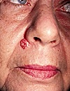 Basal Cell Carcinoma on Face face bcc