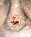 Squamous Cell Carcinoma on Nose nose scc