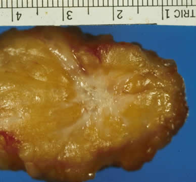 Tumor in Fatty Breast Tissue invasive breast cancer