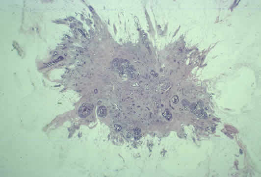 Pathologic Image of Cancerous Breast Tissue breast cancer tissue