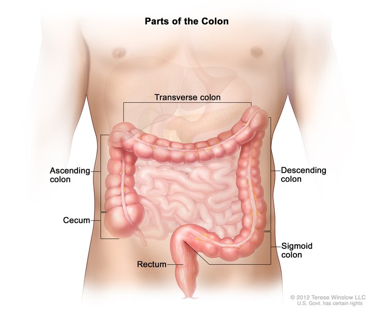 cancer de colon resumen