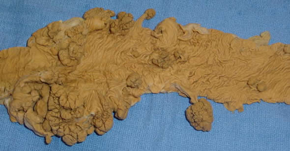 Colon And Rectal Cancer Cancerquest