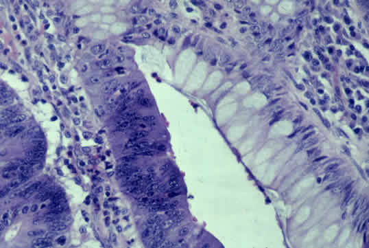 Colon Cancer Pathology colon cancer pathology