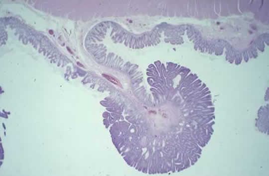 Pathology Slide of Colon Adenoma colon adenoma microscopic