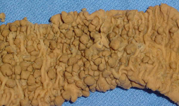 Colon with Early Adenomas ssh hat