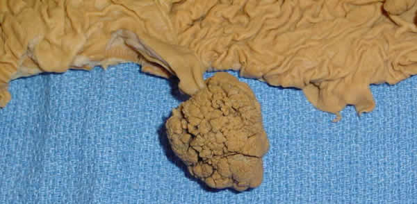 Large Adenoma in Colon mega polyp on colon