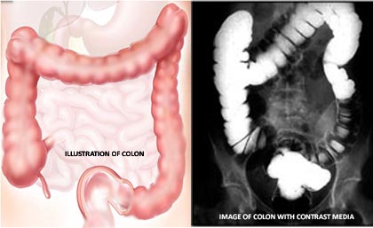 colon image with contrast media CT image of colon