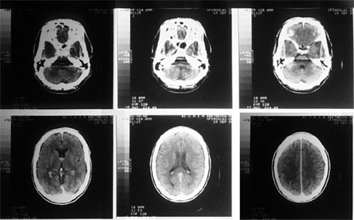 CT images of a brain brain image