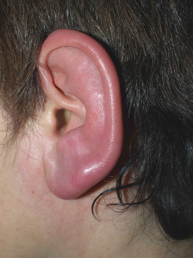 inflamed ear