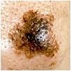 Melanoma: Abnormal Asymmetry asymmetrical