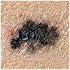 Melanoma: Irregular Border irregular border