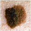 Melanoma: Abnormal Color abnormal color