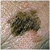 Melanoma: Large Diameter diameter