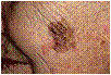 Melanoma on Face melanoma face