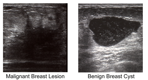 Ultrasound photos of breast cancer