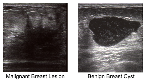 Ultrasound photos of breast cancer Ultrasound photos of breast cancer
