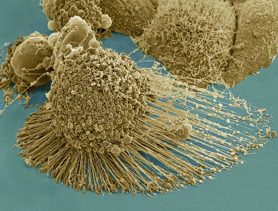 Célula HeLa muriendo mediante apoptosis