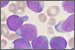 Fmn2 gene linked to B-cell acute lymphocytic leukemia.
