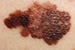 Young Women Putting Themselves At Risk For Skin Cancer.