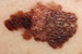 Laser technology may provide more effective, less invasive melanoma diagnosis.