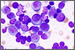 Genome sequencing furthers understanding of multiple myeloma.