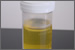 Urine Test To Detect Prostate Cancer