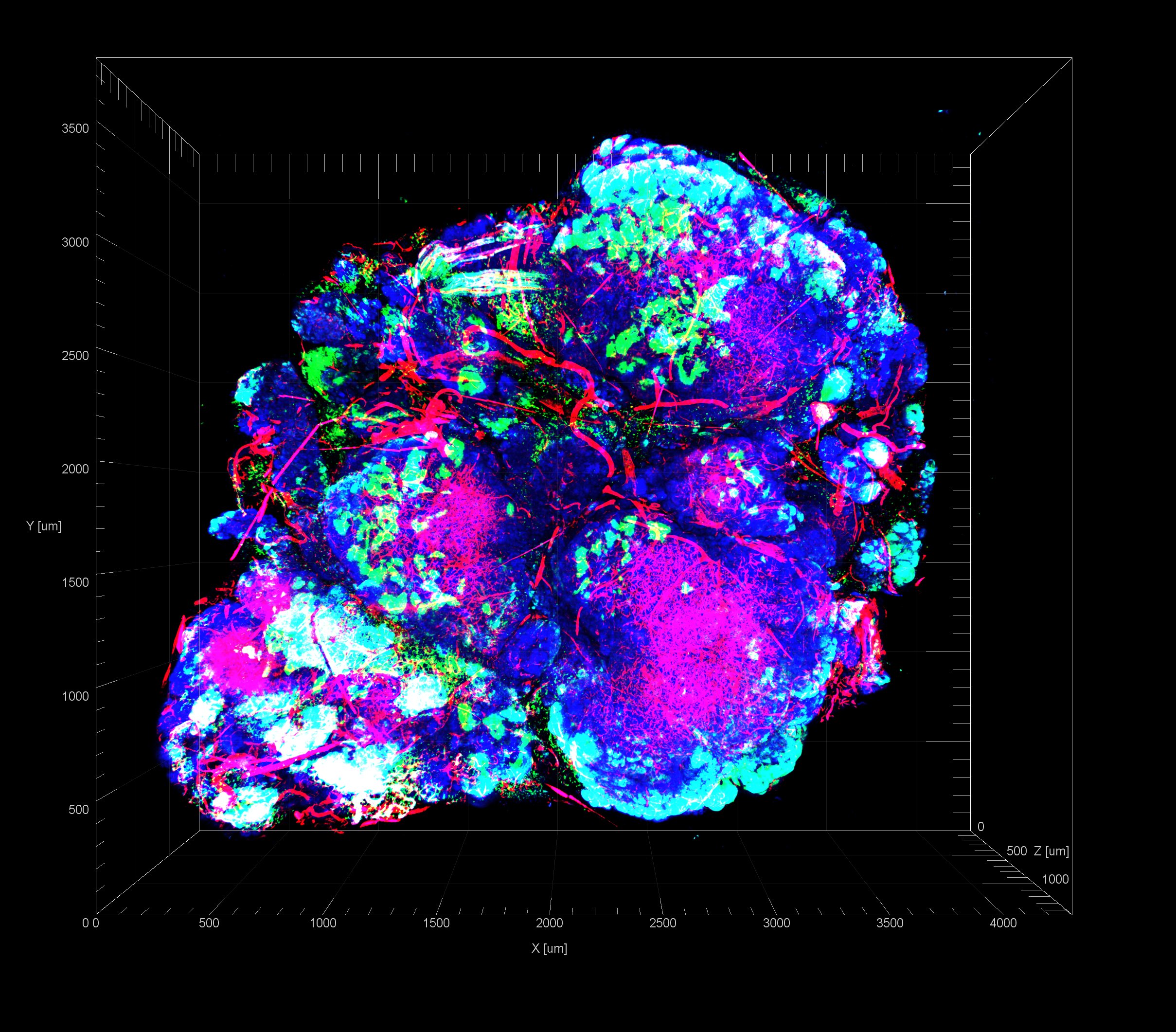 A tumor showing decreased oxygen levels (hypoxia)