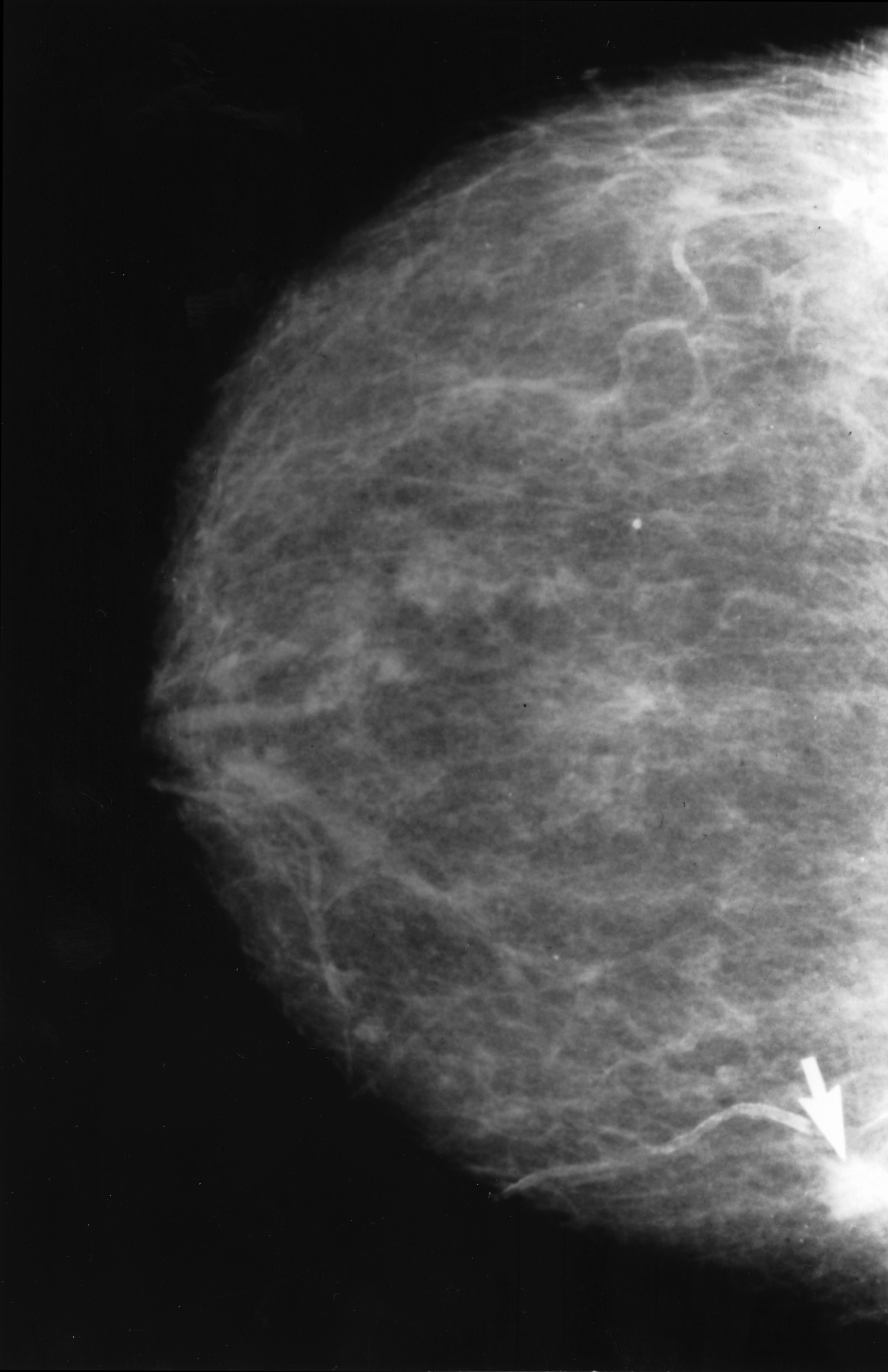 Cancer mammography.