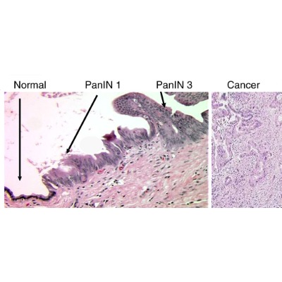 Progression of pancreatic cancer