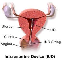 A diagram of intruterine device (IUD) in place in the uterus
