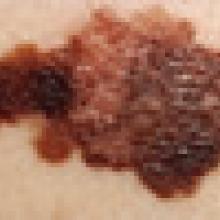 New Device Approved To Detect Melanoma.